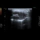 Adrenal metastasis and skeletal metastasis of pulmonary carcinoma, correlation: US - Ultrasound